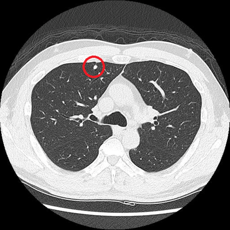 LDCT影像顯示，黃先生的右上肺處有一約0.5公分的結節，因無高度惡性特徵，僅需定期追蹤。