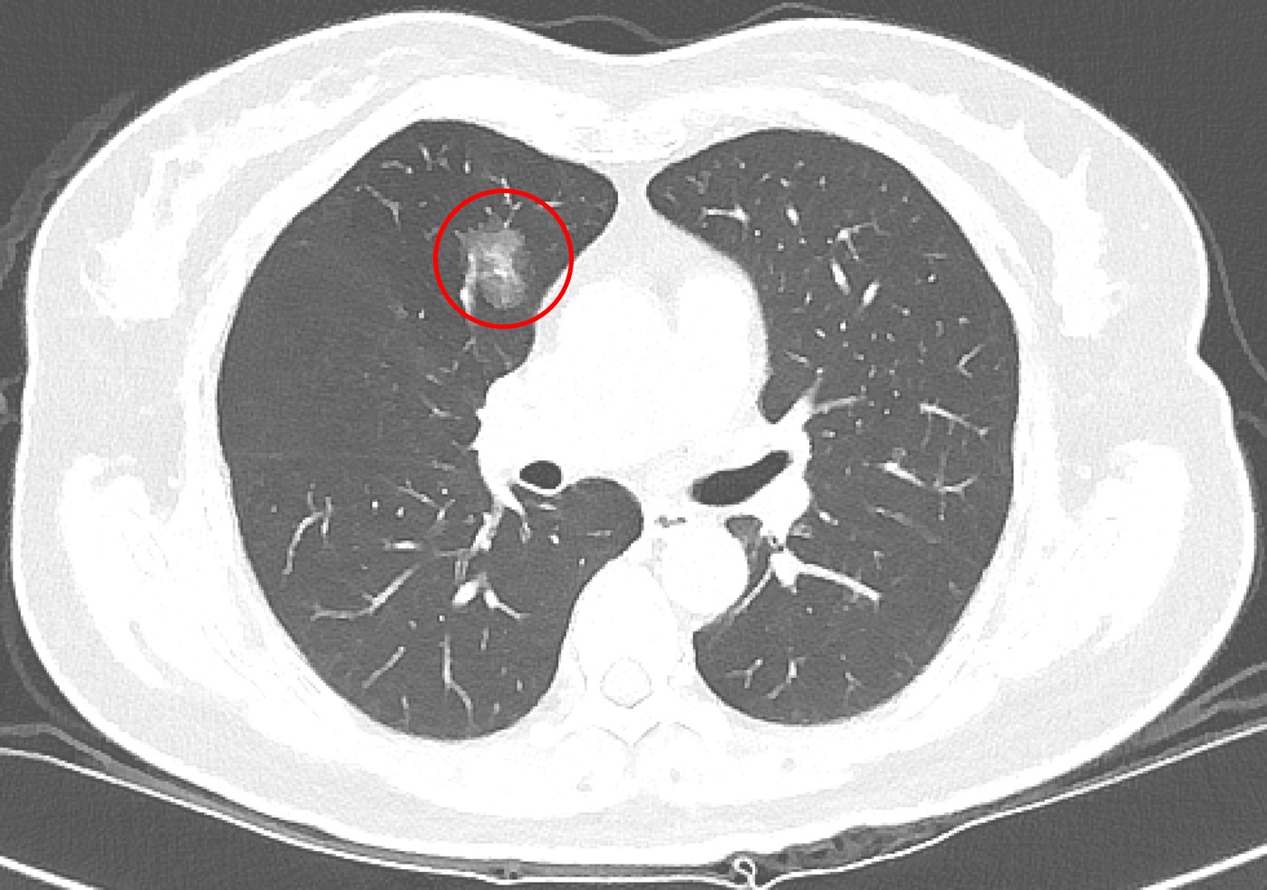 極早期的微小肺部結節，難以單就影像上確定良性或惡性，目前國內外的共識是以大小0.8公分作為最基礎的判斷準則，在困難判讀的情況下，建議須定期追蹤。 