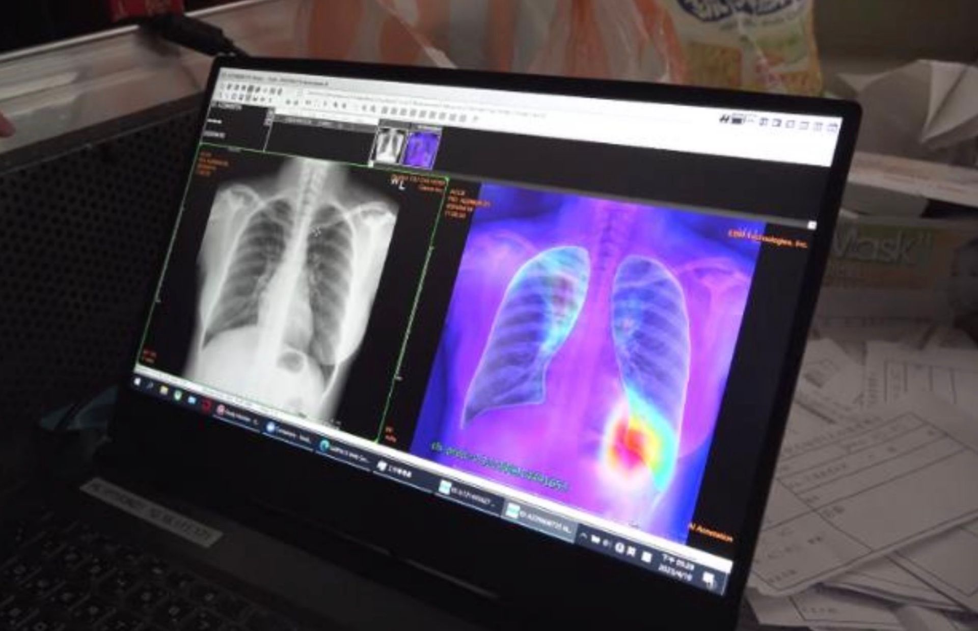 ＡＩ篩檢輔助應用在乳癌和肺結核的「智慧巡檢後，協助醫療團隊下鄉篩檢時更穩定且快速的得出結果，肺結核篩檢從原本1周縮短到10分鐘就會收到後續通知，醫護和民眾都獲得及時幫助。