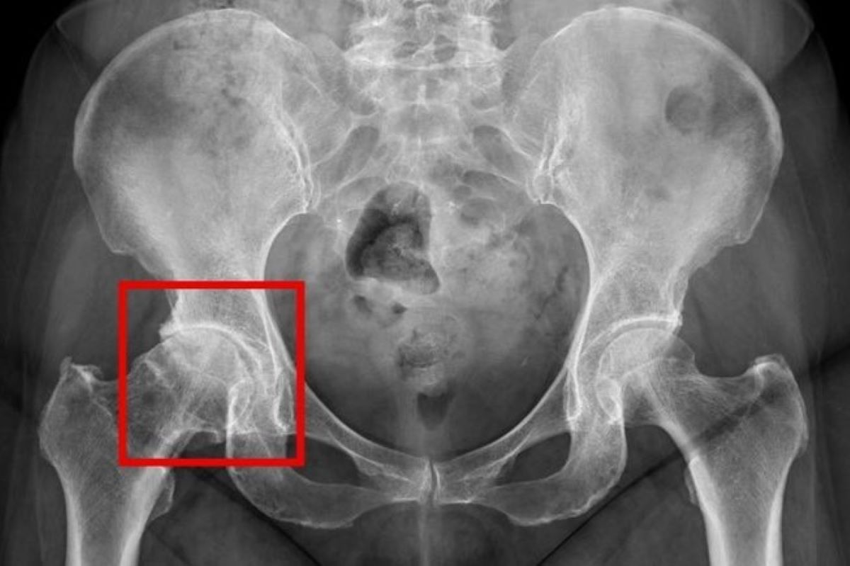 X光檢查下的退化性關節炎，紅框處可見髖關節軟骨磨損嚴重，導致骨頭間縫隙狹窄、引發發炎與疼痛。