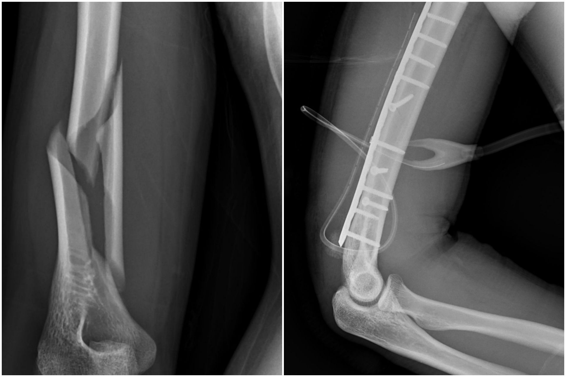 力量超過骨頭強度負荷，便可能造成螺旋性骨折，這種骨折不是外力撞擊，而是因為扭轉造成骨頭就像被擰斷一樣(左圖)。醫療團隊採取手術方式，自後側切入，在避開神經的前提下進行骨折復位，並以鋼板固定，協助骨頭穩定癒合(右圖)
