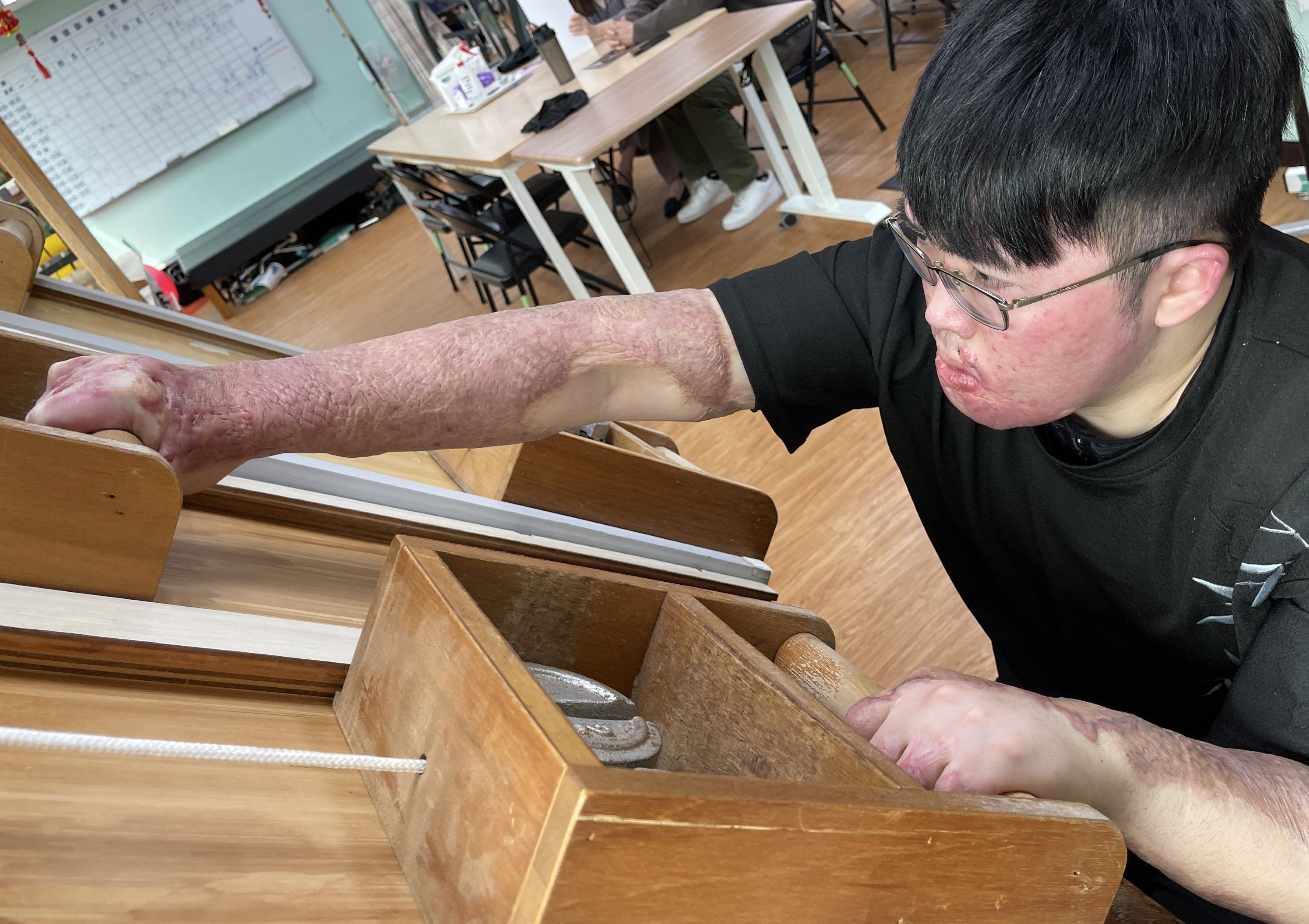 雅各雙手嚴重燒傷，陽光治療師指導進行復健。