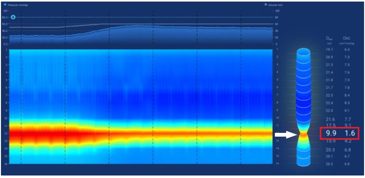 Endoflip測量下食道括約肌的擴張度，可見擴張度數值明顯偏低（正常值須大於2.8，小於2.0代表明顯過緊），食道3D重組可見明顯腰身（白箭號處）。