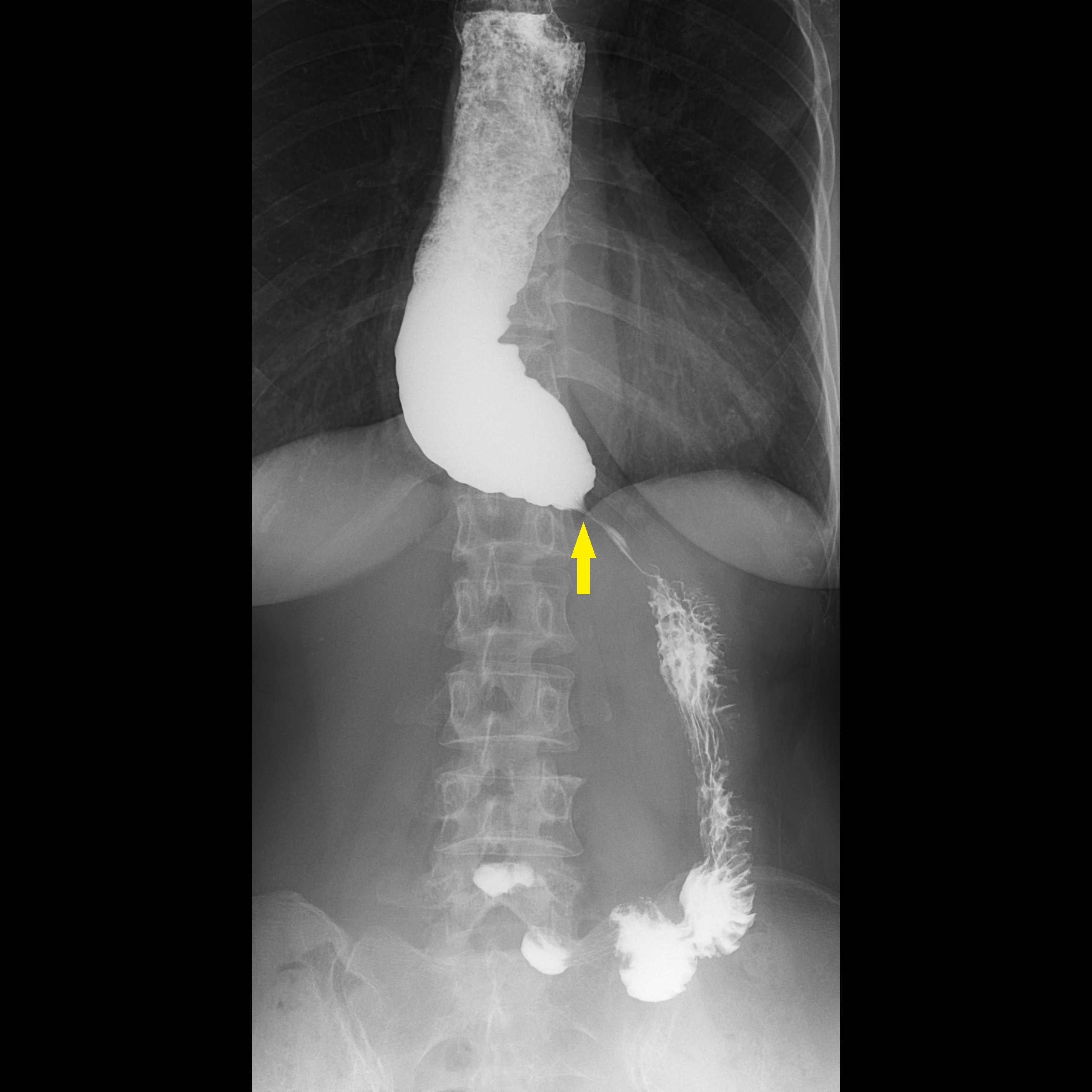 食道攝影顯示病人食道因食物過不去，上方的食道因為積壓而擴張，而下食道括約肌過緊，下方極度狹窄，如同鳥嘴般（黃箭號處）的的狀態。