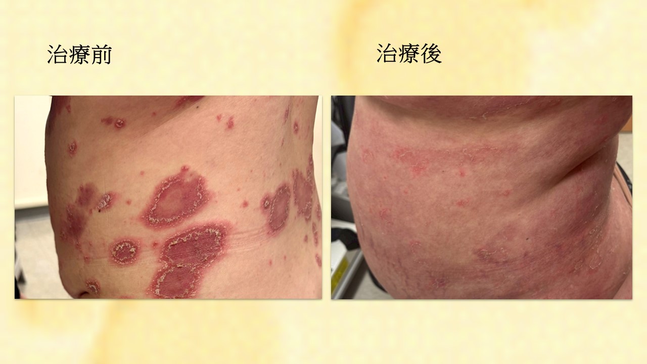 治療前後照片