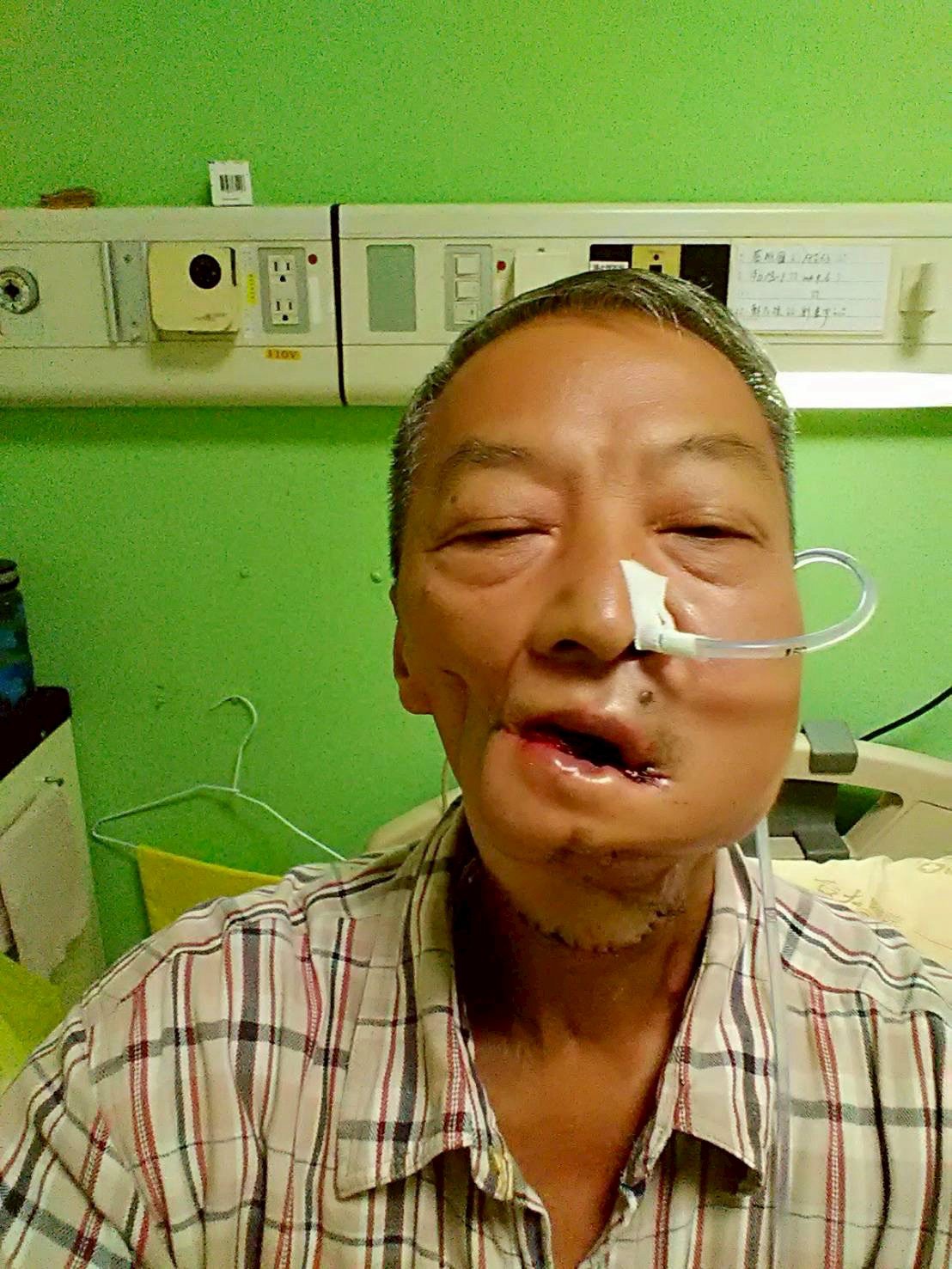 維國大哥罹患口腔癌第四期 術後改變外貌 與味覺