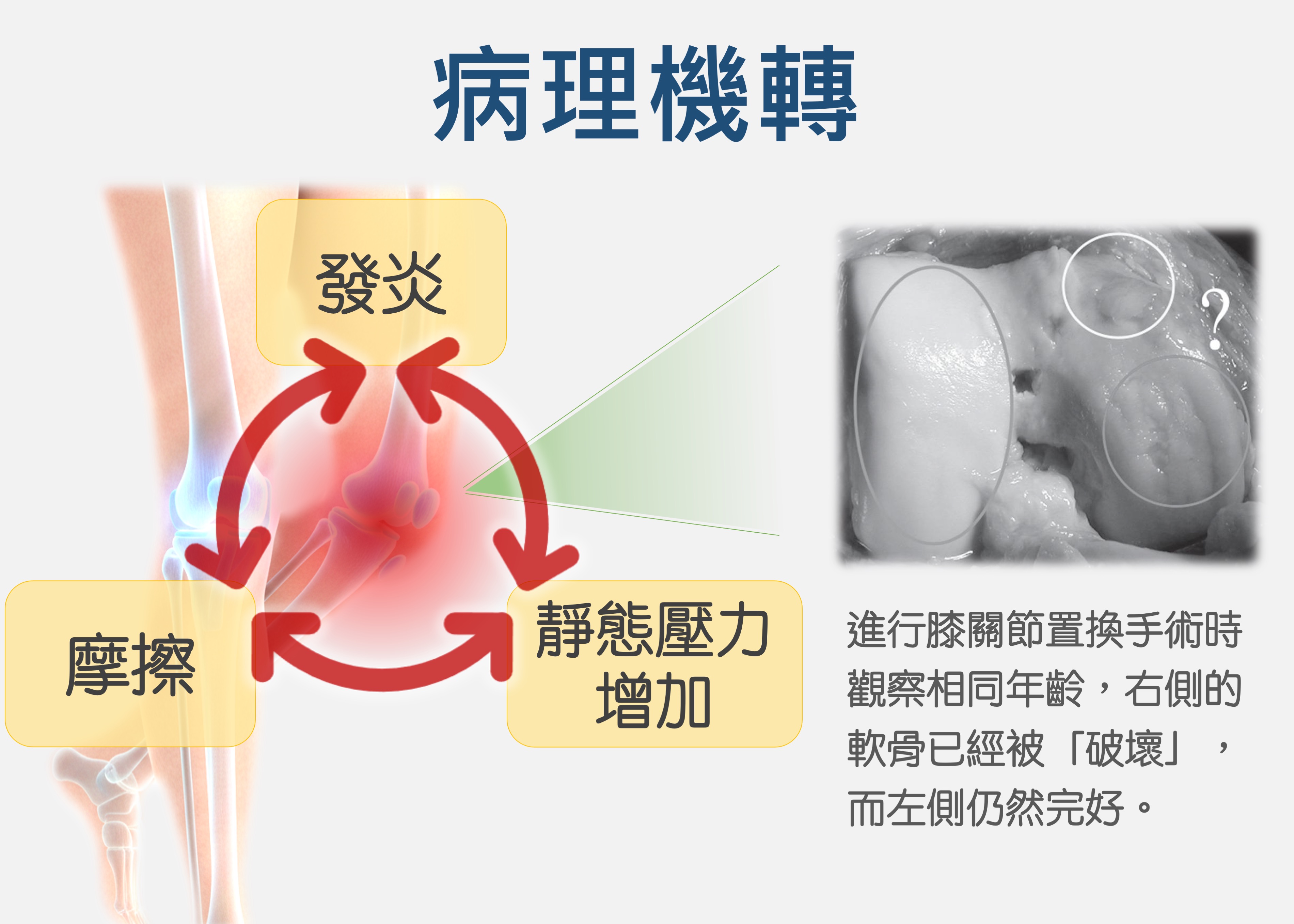 骨性膝關節炎的病理機轉說明。