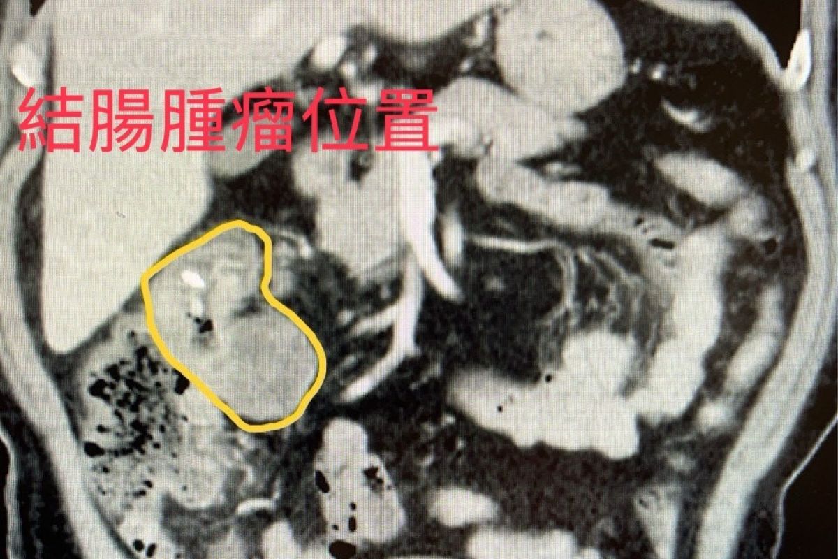 電腦斷層發現於肝臟下方的腸道有一約3公分大腫瘤。