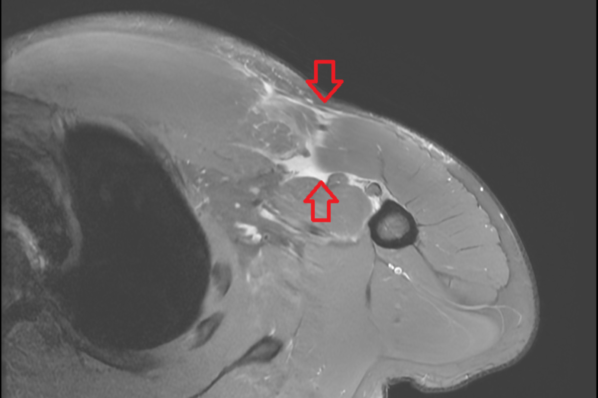 核磁共振檢查發現其右側胸大肌斷裂。
