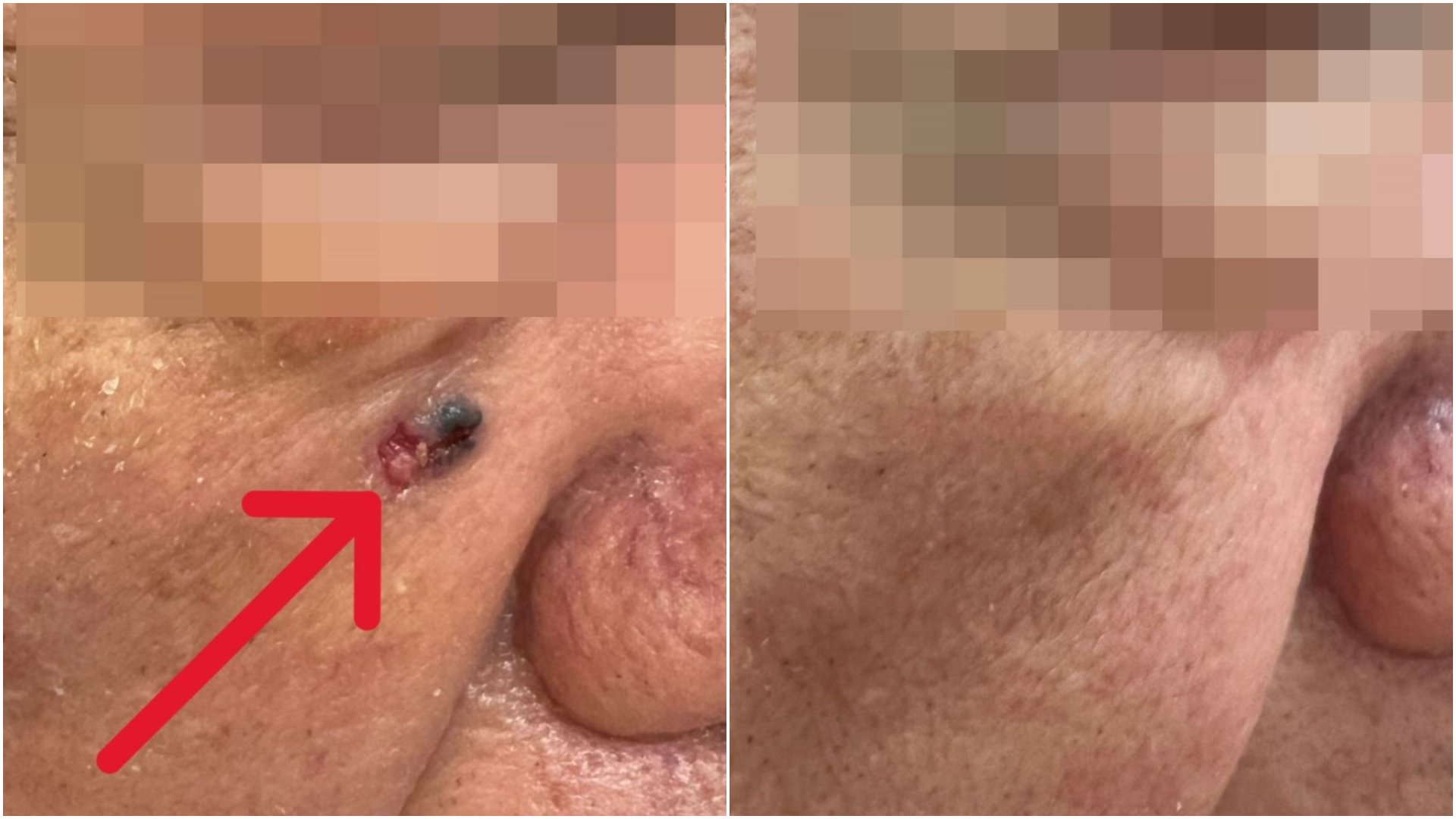 陳先生右臉出現黑色斑塊(左)，切片檢驗確診為基底細胞癌，隨即接受皮膚腫瘤廣泛性切除手術，術後恢復良好(右)，目前僅需做好日常防曬避免復發。