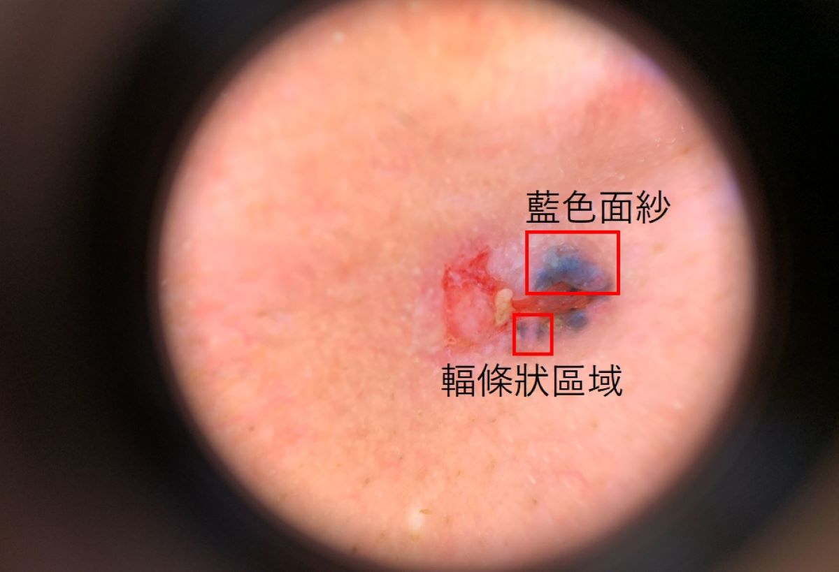 皮膚鏡檢查畫面下的病灶，可見輻條狀區域、藍白面紗、腫瘤潰瘍等基底細胞癌典型特徵。