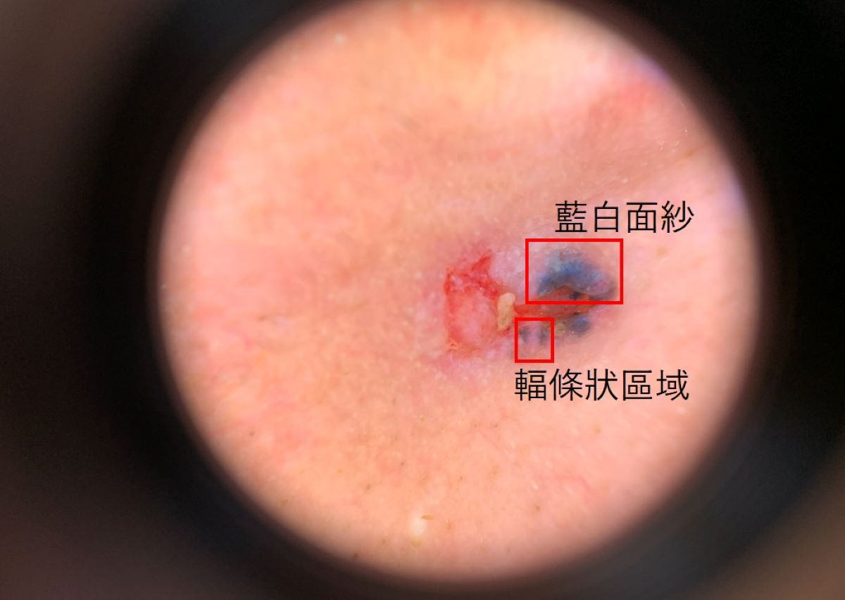 皮膚鏡檢查畫面下的病灶,可見輻條狀區域、藍白面紗、腫瘤潰瘍等基底細胞癌典型特徵。
