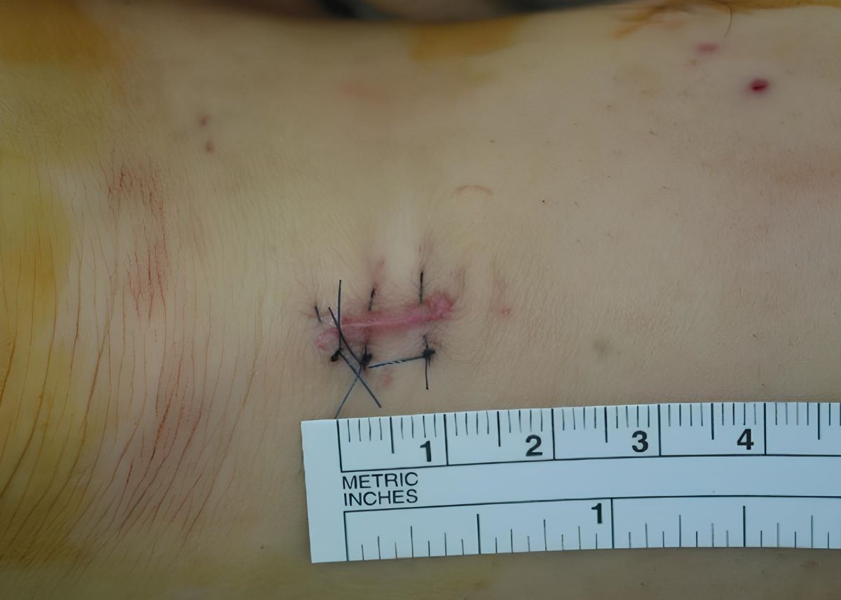 王禎麒主任帶領團隊發展超音波導引技術下的微創手術模式，手術傷口縮小至約1公分，提升安全性與精準度。