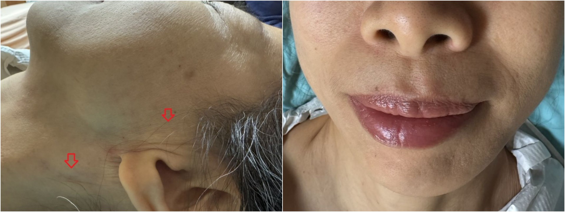 透過腮腺切除手術及頸部旋轉皮瓣修補,不僅術後傷口幾乎不可見(左),病人外貌亦不受影響(右)。