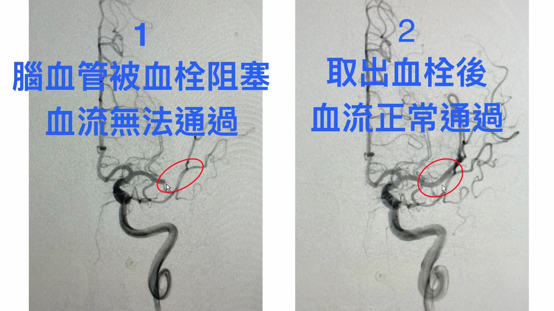 從血管攝影可以清楚看見原本腦血管被血栓阻塞時，血流完全無法通過(左)，取栓成功後血流可以正常通過(右)。