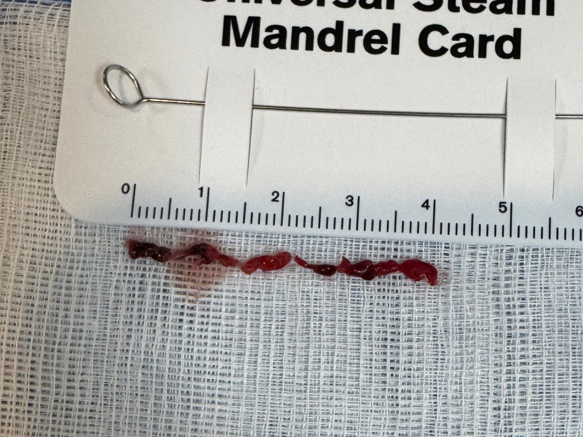 花蓮慈濟醫院醫療團隊當天為王先生緊急取出超過4公分的血栓。