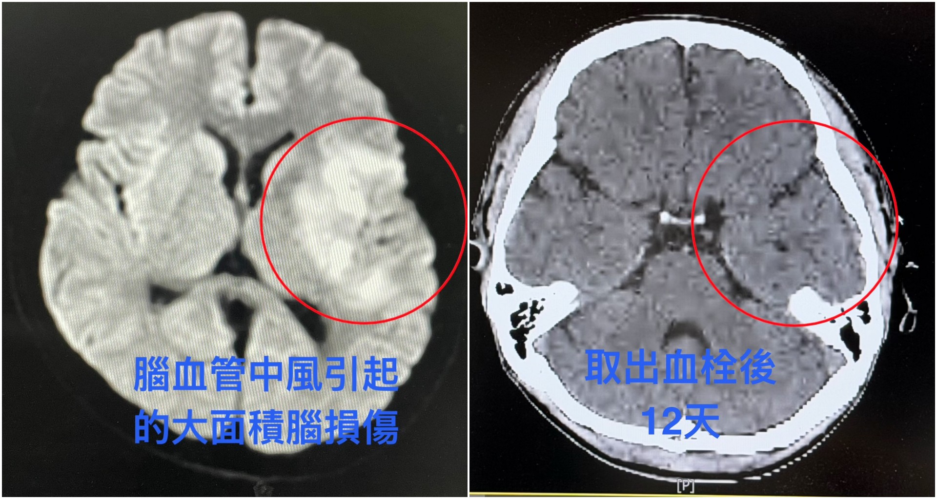 (左圖)從MRI(核磁共振)影像檢查中明顯看見，因為腦血管中風造成王先生左側腦組織大面積損傷。(右圖)術後的MRI檢查。