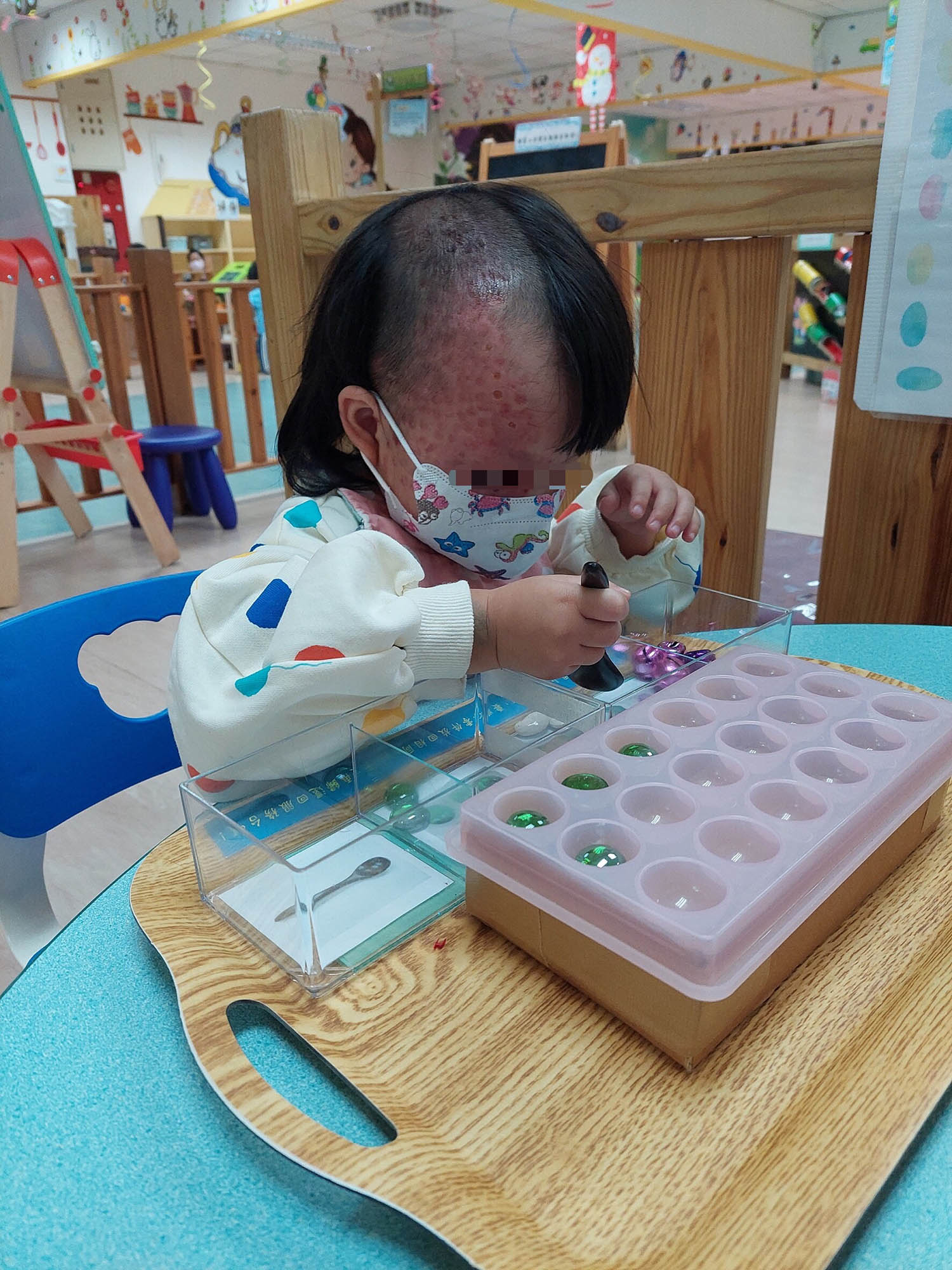 悠悠患葡萄酒色斑 為免病變持續雷射治療(此為三歲治療照片)