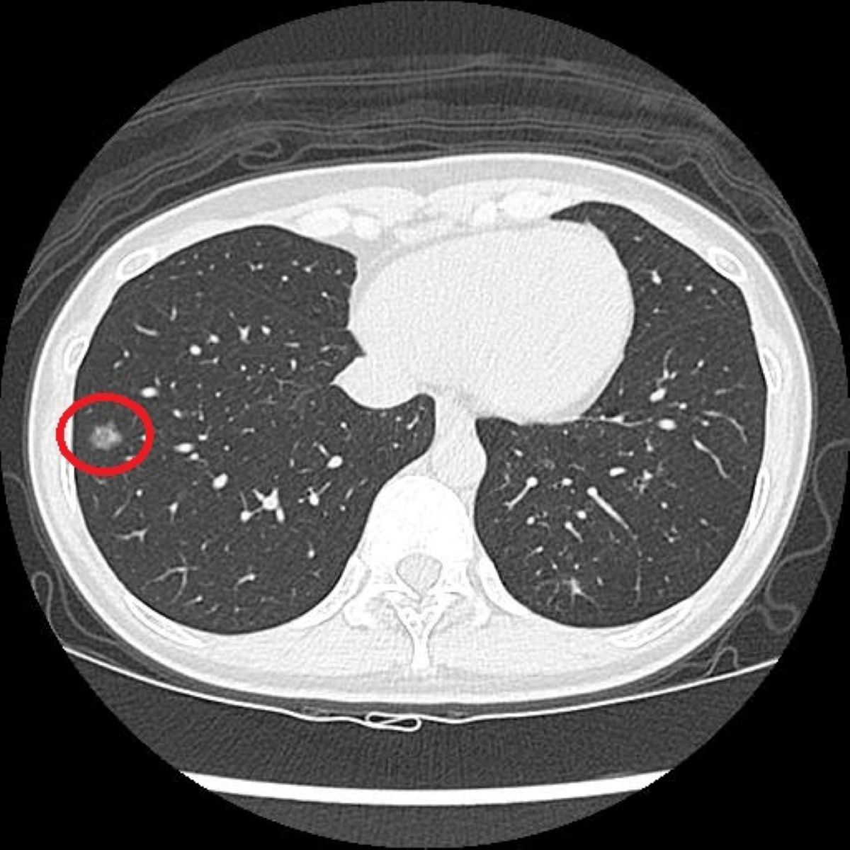 LDCT檢查顯示,陳小姐右側肺部有一1.2公分大的毛玻璃結節。
