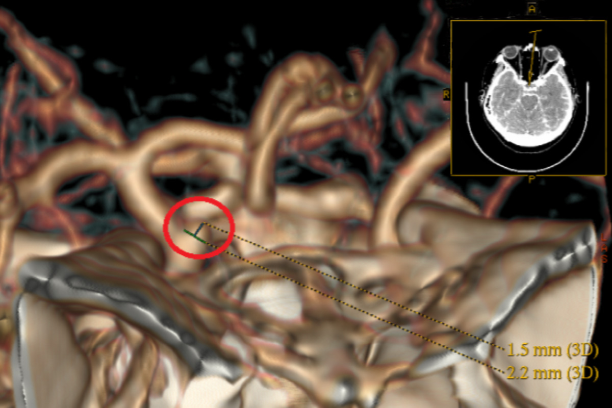 電腦斷層血管攝影顯示，內頸動脈與眼動脈之間潛藏一顆2.4毫米大的水滴型動脈瘤。