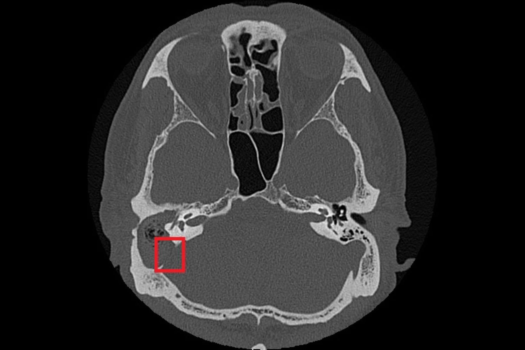 紅框處可見與後顱窩相隔的骨板被膽脂瘤侵蝕。