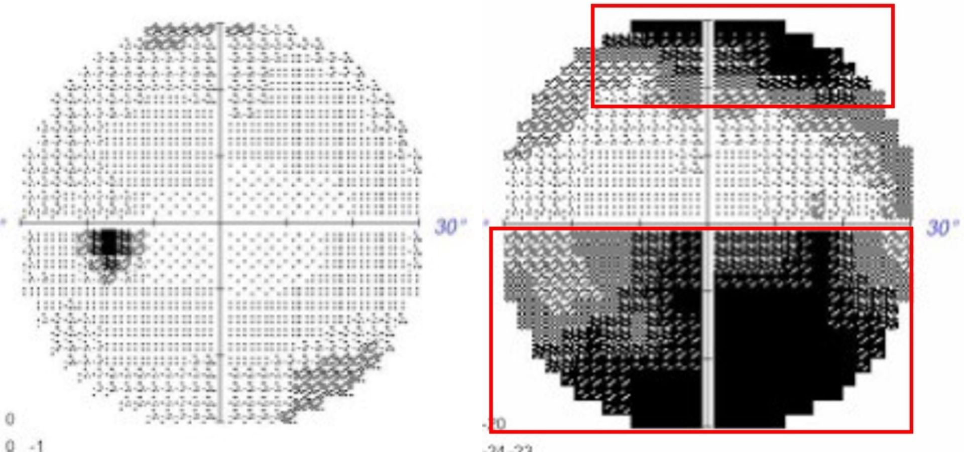 王女士的視野檢查影像,左圖為視力正常的左眼視野;右圖為視力異常的右眼,紅框部分可見視野明顯受限。