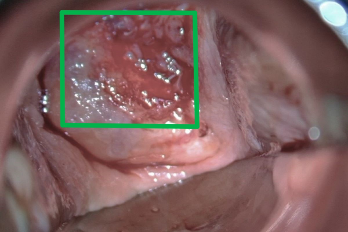 若經檢查發現子宮頸出現如綠框處的不正常出血及糜爛症狀，會進一步切片確認是否為癌變。