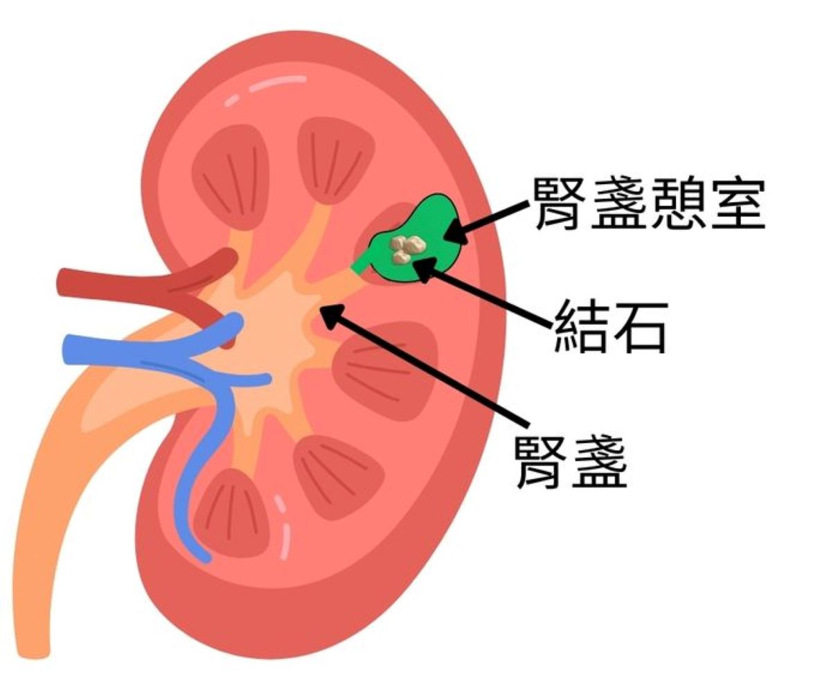 腎盞憩室構造與結石示意圖。