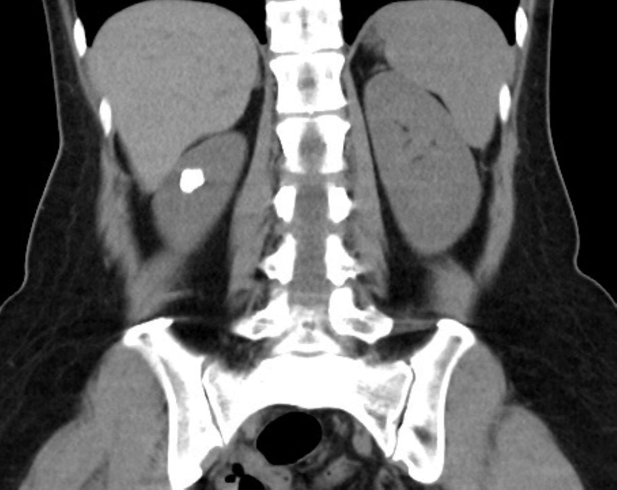 電腦斷層影像中，可見田女士左側腎臟的結石集合體嵌在憩室內。