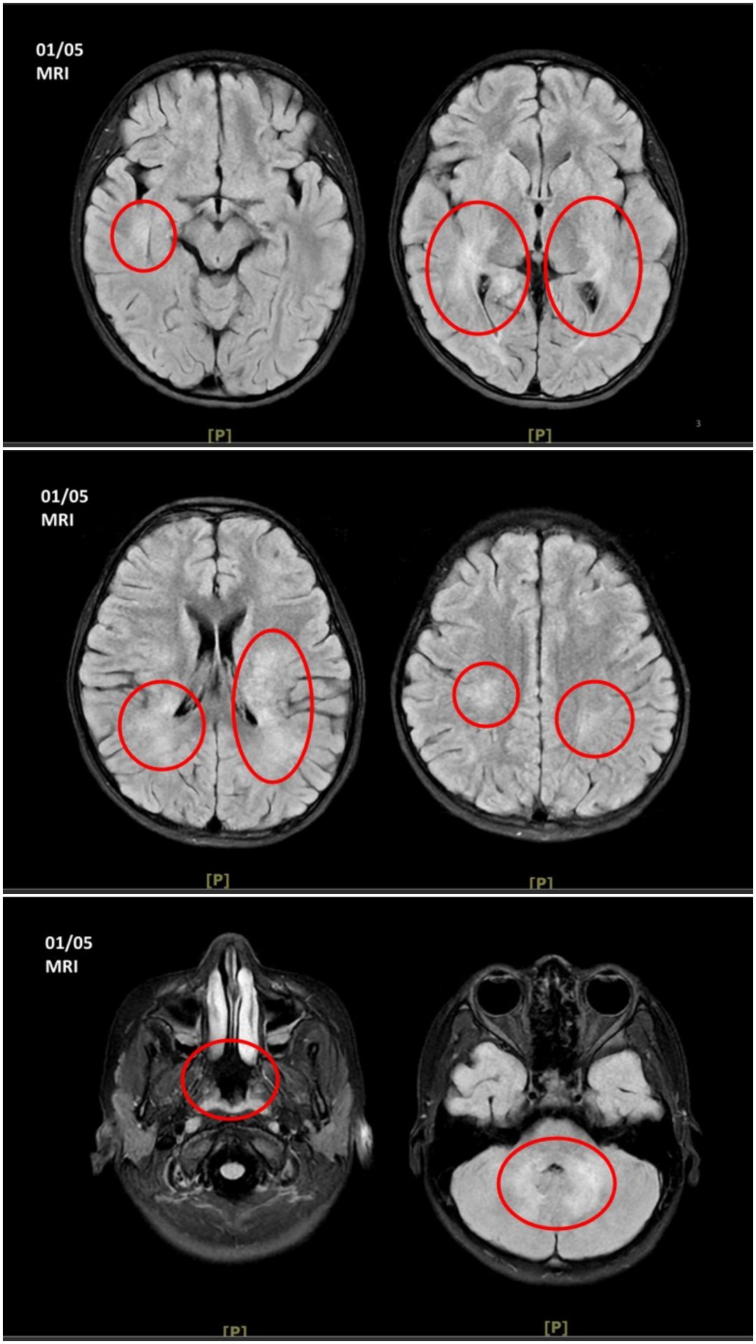 王傳育主任說，檢查結果顯示，女童小腦、視丘及大腦白質、皮質下都可見異常訊號，符合急性散播性腦脊髓炎的影像表現。