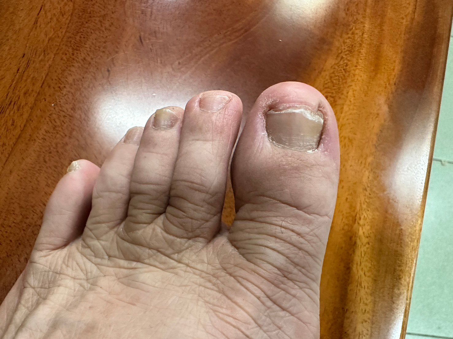 林騰立醫師特別提醒,修剪指甲應「平平地剪」,避免剪得過短或過圓,防止甲側皮膚向內擠壓,形成惡性循環。