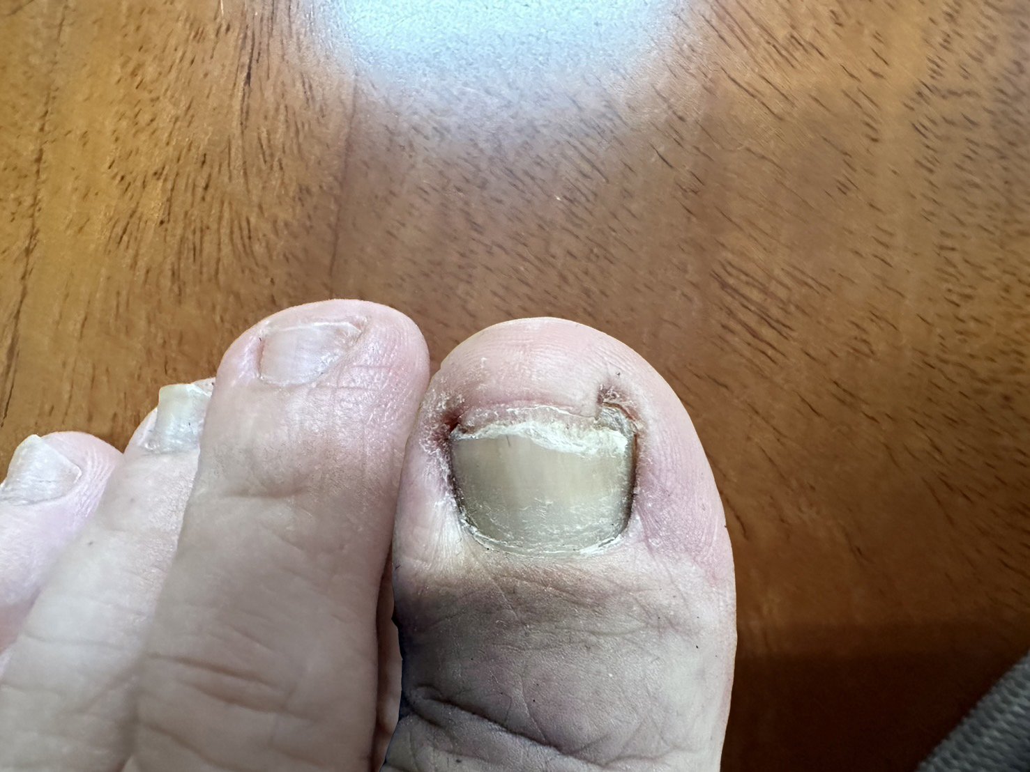 造成凍甲的後天因素則包括灰指甲、乾癬等疾病導致指甲變形。