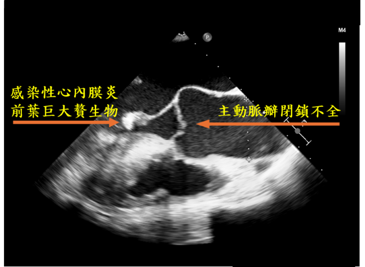 圖為經食道心臟超音波影像,標示處可見主動脈瓣膜閉鎖不全,及因心內膜炎造成的贅生物。