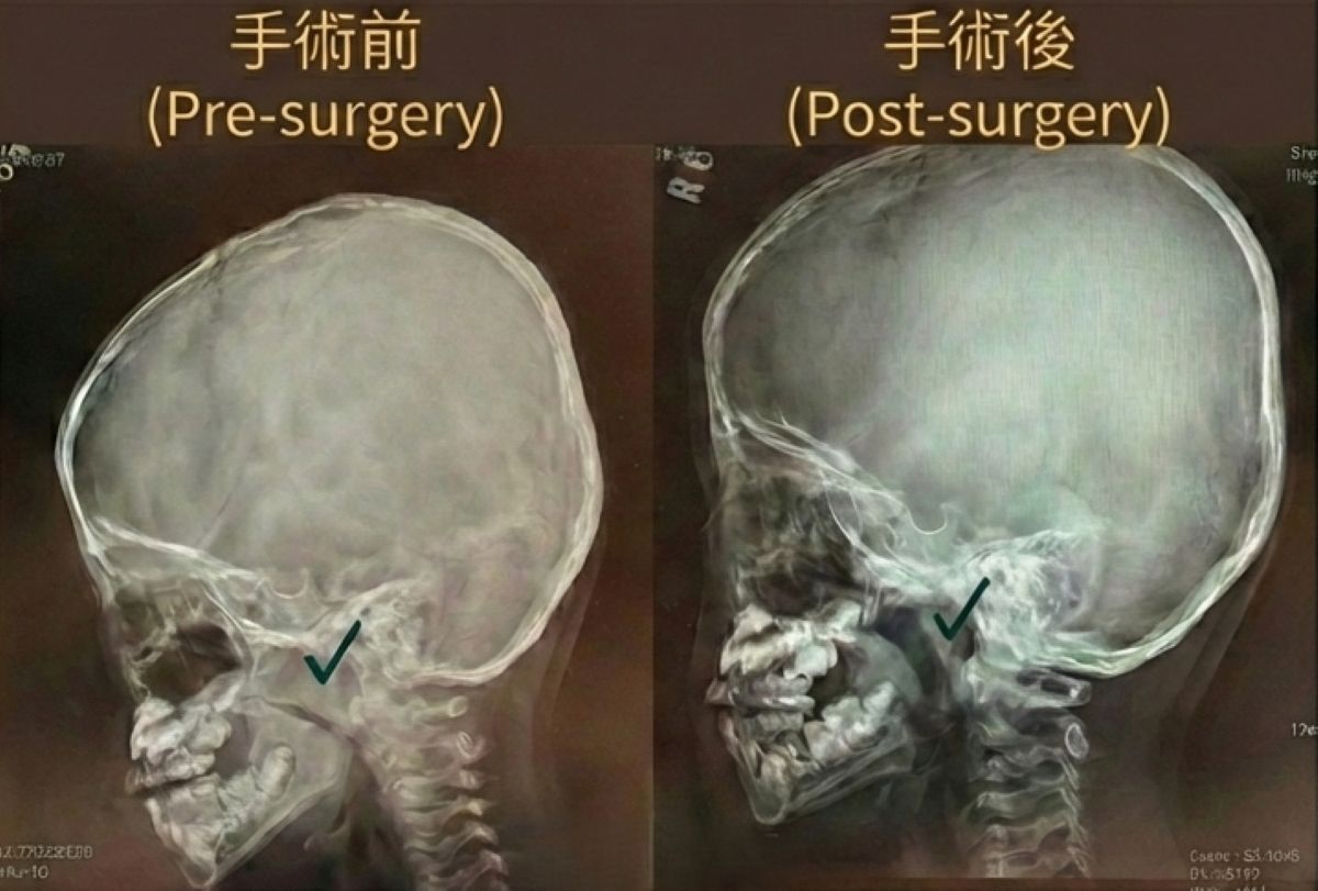 兒童鼻塞影響發育別輕忽 手術提升鼻腔通氣順暢